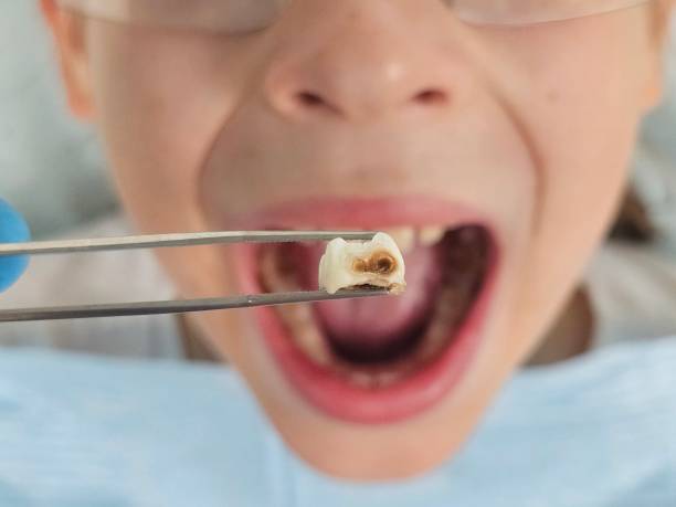 Best Urgent Care for Lost Fillings or Crowns in Westby, WI